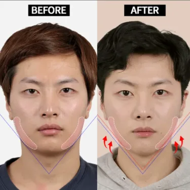 Контурная пластика лица