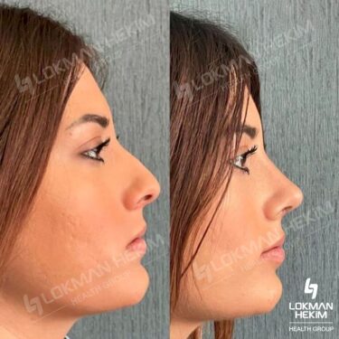 Ринопластика