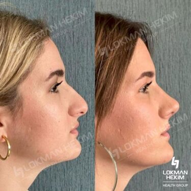 Ринопластика