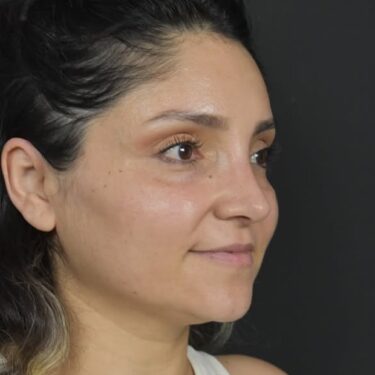 Ринопластика