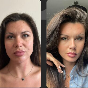 Подтяжка лица