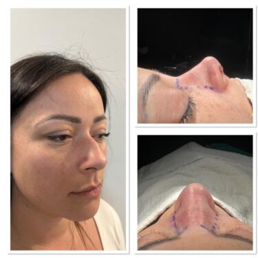 Ринопластика