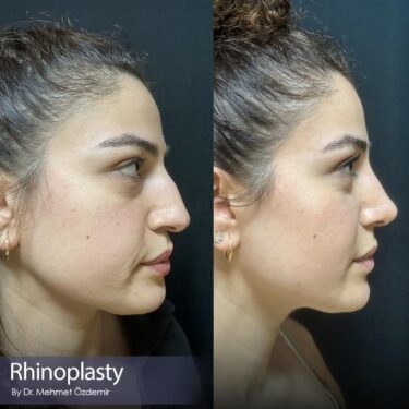 Ринопластика