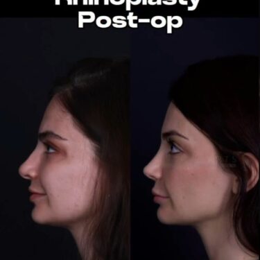 Ринопластика