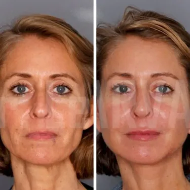 Face and neck lift