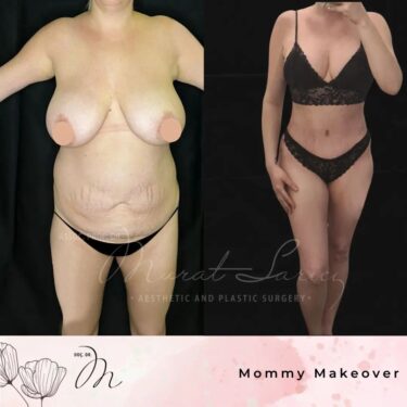 Mommy Makeover
