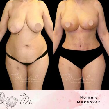 Mommy Makeover