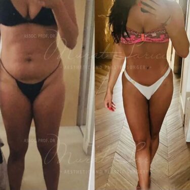 Абдоминопластика и липосакция