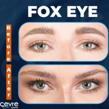 Блефаропластика