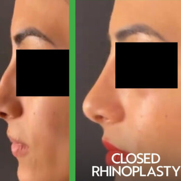 Ринопластика