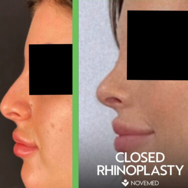 Ринопластика