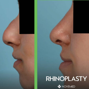Ринопластика