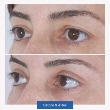 Подтяжка лица