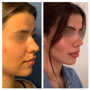 Ринопластика