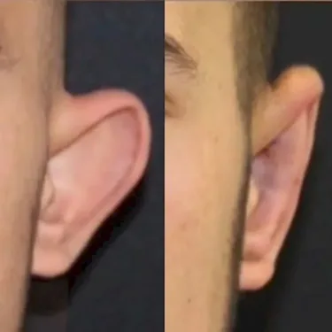 Otoplasty in Turkey