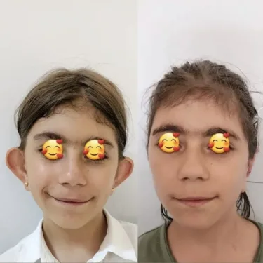 Otoplasty in Turkey