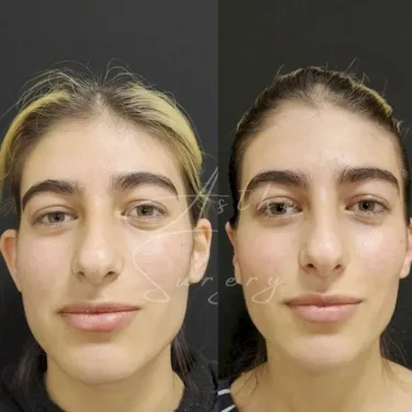 Otoplasty in Turkey