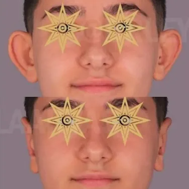 Otoplasty in Turkey