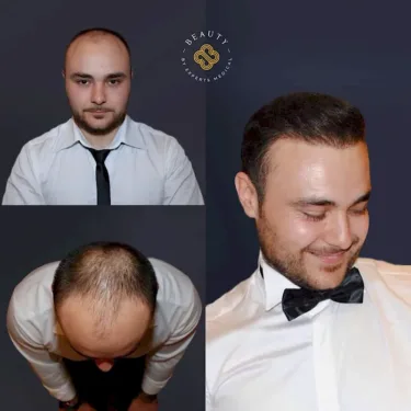 Hair transplantation