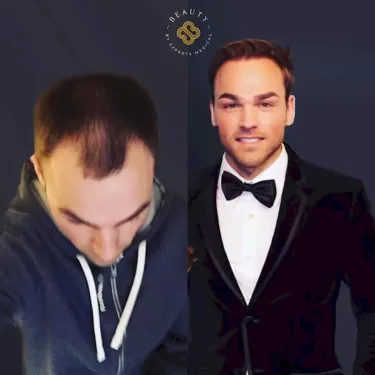 Hair transplantation