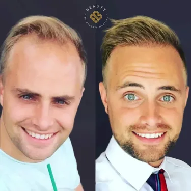 Hair transplantation