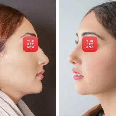 Ринопластика