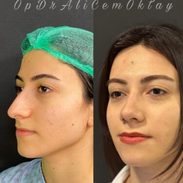 Ринопластика