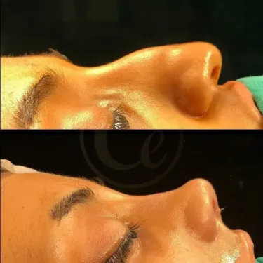 Rhinoplasty