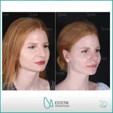 Ринопластика