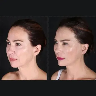 Подтяжка лица