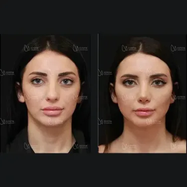 Подтяжка лица