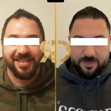 Пересадка волос