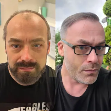 Hair Transplant