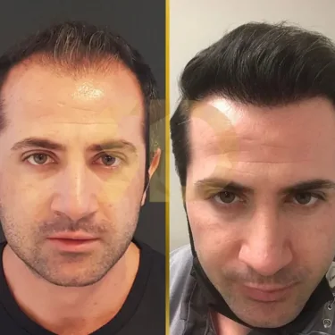 Hair Transplant