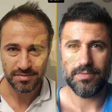 Hair Transplant