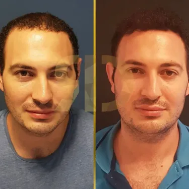 Hair Transplant