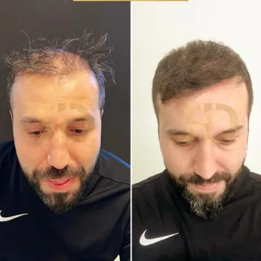 Hair Transplant