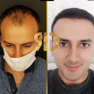 Hair Transplant