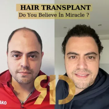 Hair Transplant