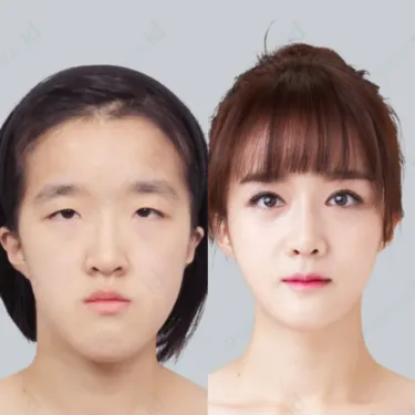 Контурная пластика лица