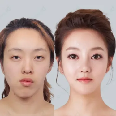 Контурная пластика лица