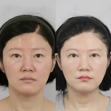 Facelift