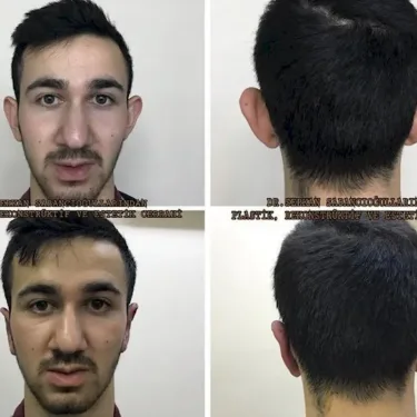 Otoplasty in Turkey