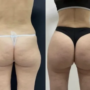 Бразильская подтяжка ягодиц (BBL)