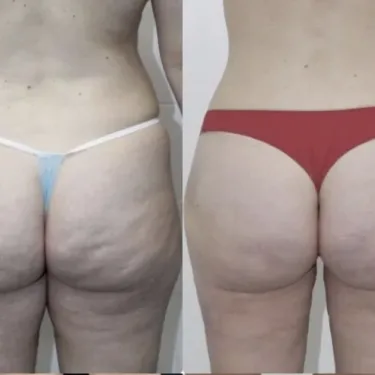 Бразильская подтяжка ягодиц (BBL)