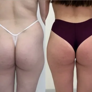 Бразильская подтяжка ягодиц (BBL)