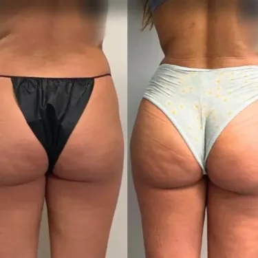 Бразильская подтяжка ягодиц (BBL)