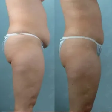 Липосакция