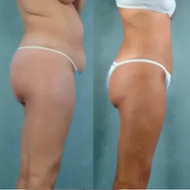 Липосакция