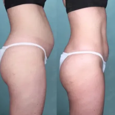 Липосакция